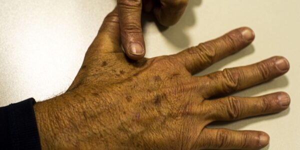 cancer_de_pele_melanoma20220520_0621.jpg